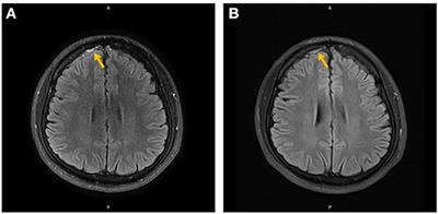 High-Resolution Magnetic Resonance Black Blood Thrombus Imaging and Serum D-Dimer in the Confirmation of Acute Cortical Vein Thrombosis